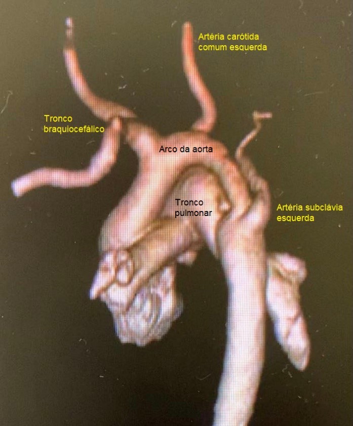 Angiotomografia computadorizada de tórax - dilatação do tronco da artéria pulmonar, hipertrofia das paredes do ventrículo direito e dimensões muito aumentadas do átrio esquerdo.